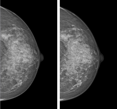 Two X-ray images (mammograms) of a breast in side profile; both show breast tissue as greyish-white on black background; the image on the right has brighter areas that indicate regions of higher brest tissue density.