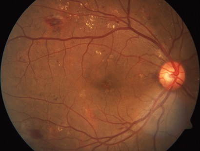 A close-up scan of a retina with diabetic retinopathy, with various smudges visible.
