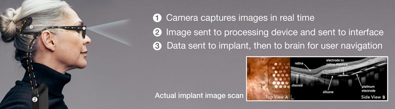 Bionic vision processing diagram