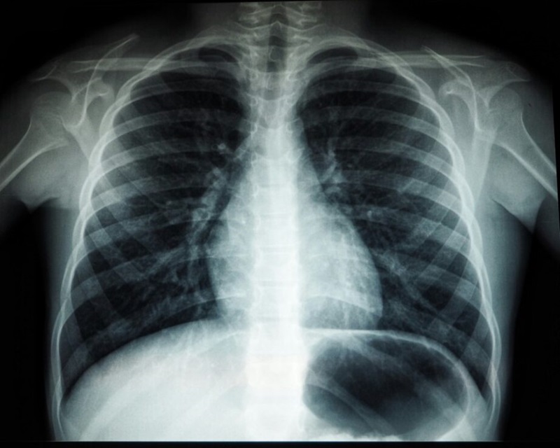X-ray of the human body, showing ribs, spine