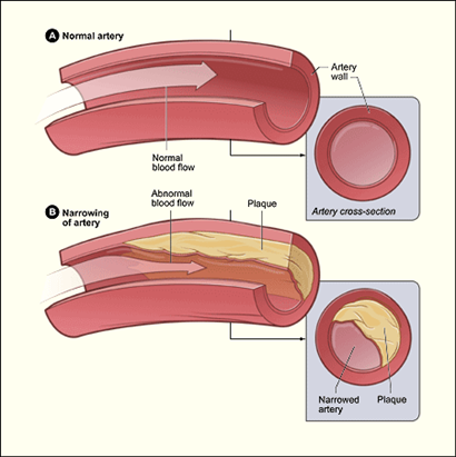 A diagram showing a normal artery with normal blood flow and an artery containing plaque build-up.