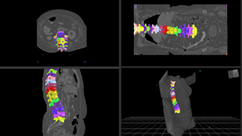 spinal segmentation imaging 