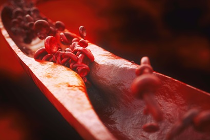 A 3D rendering of atherosclerosis, an underlying cause of cardiovascular disease where plaques build up on artery walls, restricting or even blocking blood flow throughout the body.