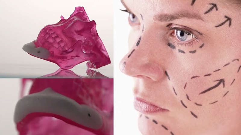 Women's face next to Porestar implant