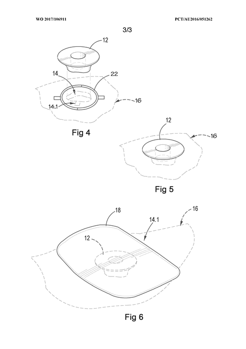 Courtesy of Singular Health; Figure 6 is a diagrammatic representation of a custom moulded stoma insert in accordance with one aspect of the invention having an ostomy bag or pouch fitted thereto.