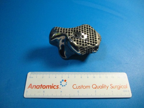 3D titanium heel bone implant with ruler
