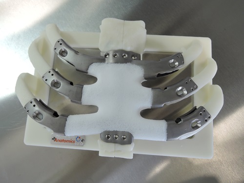 3D printed sternum and rib cage transplant