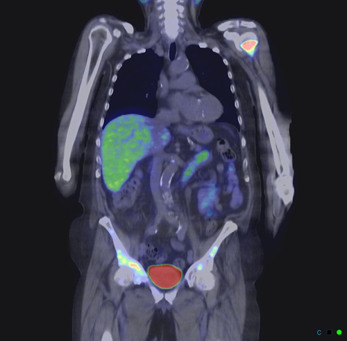 A PET scan shows metastasised prostate cancer cells glowing in red in the shoulder and pelvis.