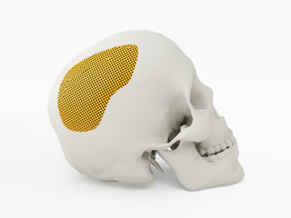 A 3D simulation of a skull with an AI-generated printed cranial implant.