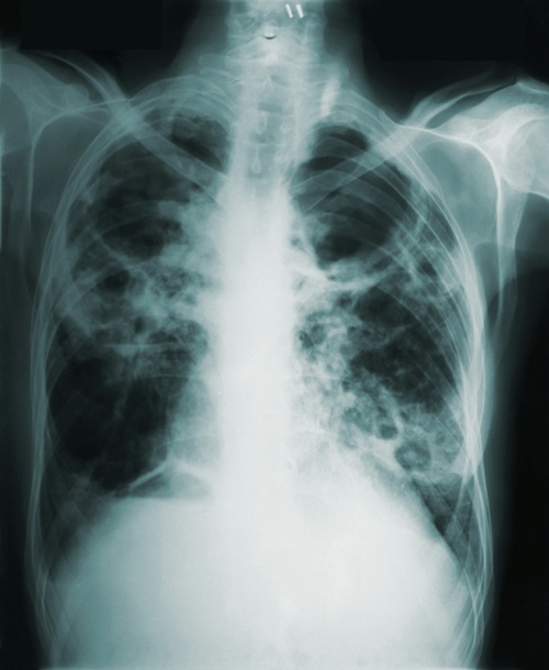 Chest x-ray