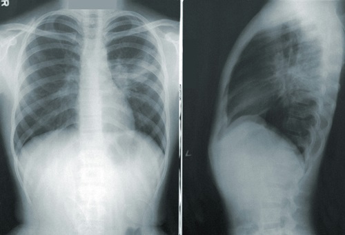Chest x-ray