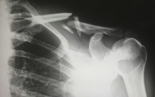Shoulder x-ray