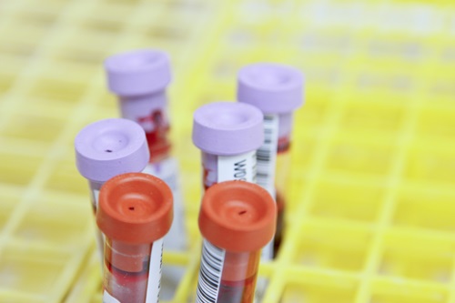 Close-up image of six blood sample test tubes placed in a yellow grid rack. The test tubes have either purple or red caps and contain blood. Some of the test tubes have barcode labels attached.