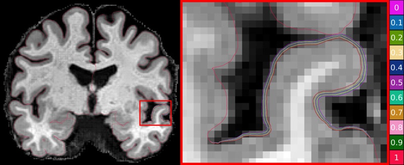 Two brain MRI scans. One up close and one a cross section of the brain. 